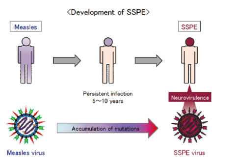 亜急性硬化性全脳炎（SSPE）発症メカニズムの解明